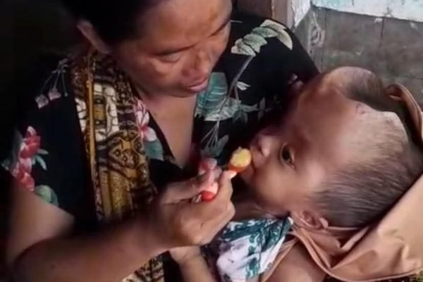 Kondisi adik Alia Sidkia Suci pengidap penyakit hidrosefalus.